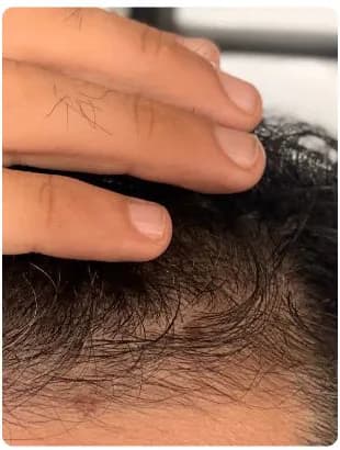 sohailinho's hairline after two months on MINX